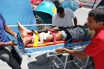 Carona de moto sofreu fratura exposta na perna em colisão com carro de som de vereador