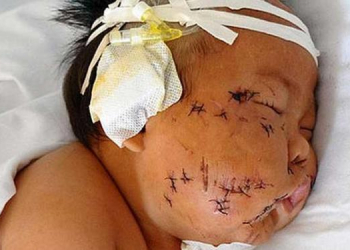 Bebê leva 90 tesouradas da mãe durante amamentação