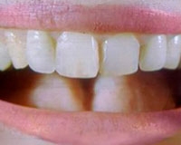 Cientistas chineses recriam dentes a partir do uso de urina humana