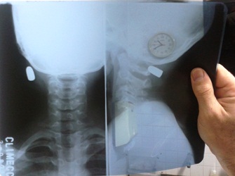 O projétil poderia ter atingido também a primeira vértebra da coluna, o que poderia deixá-lo paraplégico.