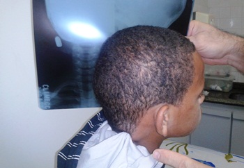 O tecido do capuz penetrou com a bala, mas não furou.Milagre?