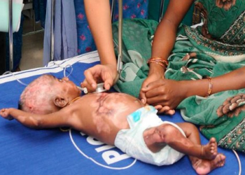 Na Índia, bebê de três meses pega fogo pela quarta vez por conta de doença rara