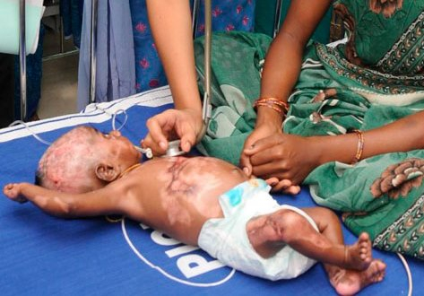 Na Índia, bebê de três meses pega fogo pela quarta vez por conta de doença rara