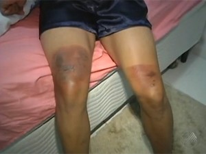 Vítima de atentado mostra queimaduras nas pernas (Foto: Reprodução / TV Bahia)