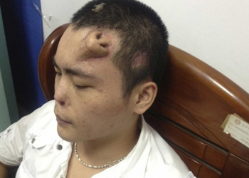China: cirurgiões fazem crescer nariz artificial em testa de paciente