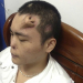 China: cirurgiões fazem crescer nariz artificial em testa de paciente