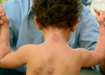 Bebê é mordida cerca de 50 vezes em creche