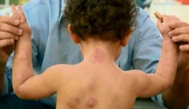 Bebê é mordida cerca de 50 vezes em creche