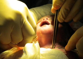 Cirurgia inédita é realizada em bebê na Bahia