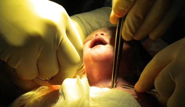 Cirurgia inédita é realizada em bebê na Bahia