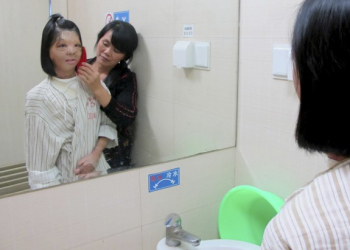 Chinesa faz cirurgia de reconstituição de face ‘cultivada’ em seu peito