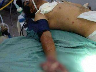 Bandido tenta explodir caixa eletrônico e tem mão dilacerada