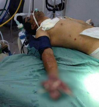 Bandido tenta explodir caixa eletrônico e tem mão dilacerada