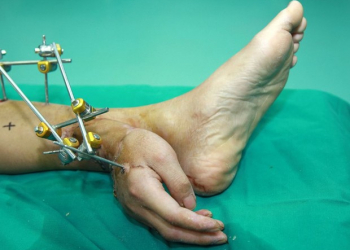 Homem faz cirurgia para reimplante de mão após membro ficar 1 mês ligado a tornozelo