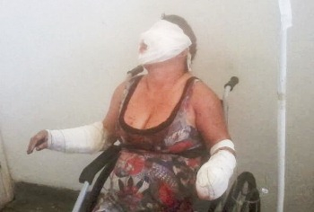 Ipirá: explosivo detona e fere mulher gravemente