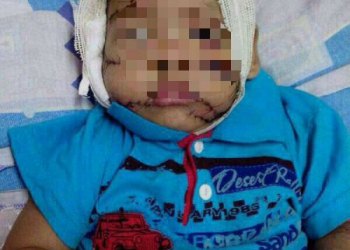 Criança é atacada por pitbull e tem rosto desfigurado