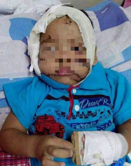 Criança é atacada por pitbull e tem rosto desfigurado