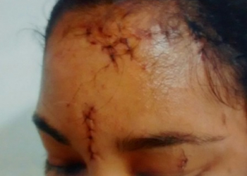 Mulher leva dezessete pontos após levar garrafada no rosto