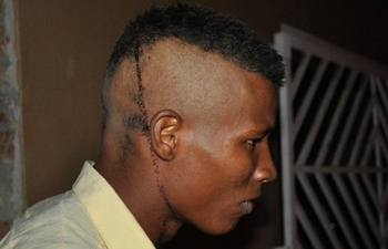 Após tiro na cabeça, homem anda 2 km e recusa ida ao hospital