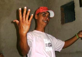 Queimadas – Corpo de Amauri é sepultado; ele já havia sofrido grave acidente e ex-namorada morreu cinco dias antes.