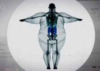 Ressonância de homem de 406 kg deixa internautas chocados