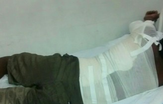 Homem teve cerca de 30% do corpo queimado