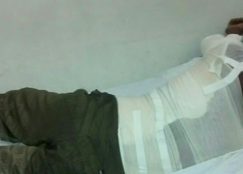 Homem joga gasolina e ateia fogo em amigo na zona rural