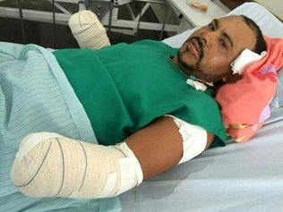 Homem que teve as mãos decepadas acusados de roubo de bode nega crime