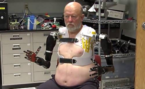 Americano sem os dois braços ganha próteses controladas por pensamento