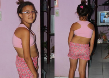Coité – Mãe coloca casa a venda para tentar realizar cirurgia da filha que sofre de Escoliose