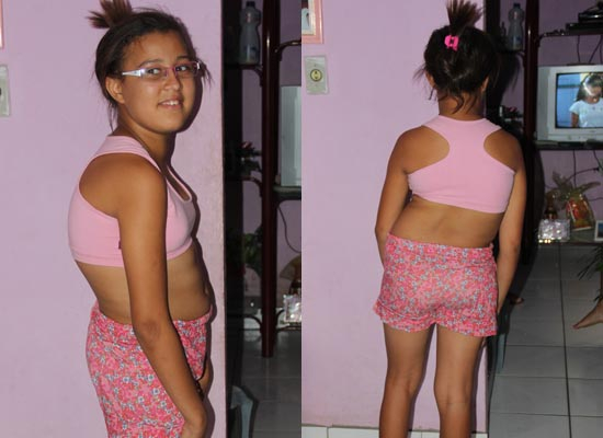 Coité – Mãe coloca casa a venda para tentar realizar cirurgia da filha que sofre de Escoliose