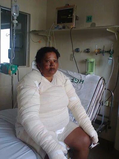 Morre no HGE coiteense que teve o corpo queimado pelo ex-companheiro