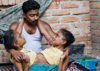 Aos 45 anos, gêmeas siamesas dividem o mesmo namorado na Índia
