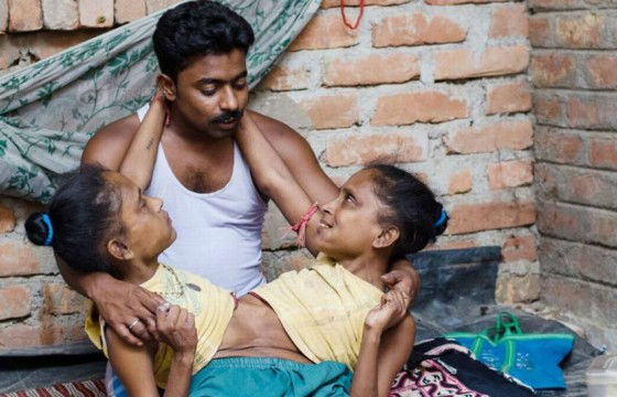 Aos 45 anos, gêmeas siamesas dividem o mesmo namorado na Índia