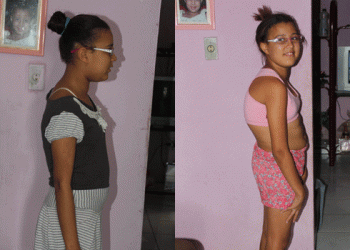 Coité – Garota Rebeca  se recupera bem da cirurgia de escoliose