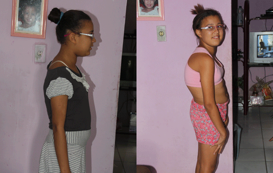 Coité – Garota Rebeca  se recupera bem da cirurgia de escoliose