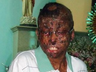 Com doença rara e sem cura, baiano de 21 anos já passou por 130 cirurgias