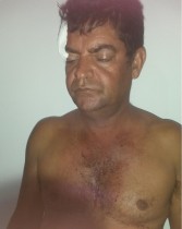 Vitima por pouco não perdeu o olho.