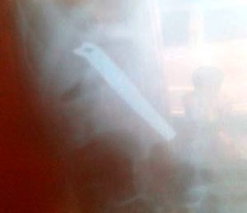 Criança de 6 anos é internada após engolir parte de cortador de unha