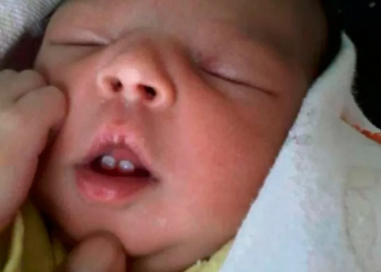 ES: Em caso raro, bebê nasce com dois dentes