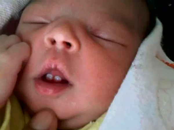 ES: Em caso raro, bebê nasce com dois dentes