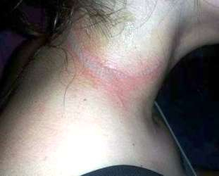 Celular causa queimaduras de 2º grau em menina de 13 anos