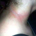 Celular causa queimaduras de 2º grau em menina de 13 anos