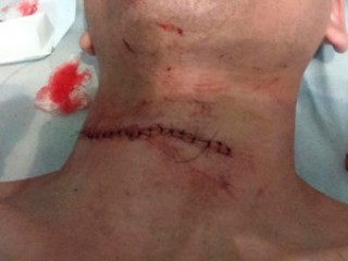 Estudante sobrevive após ter pescoço cortado por linha de pipa: ‘milagre’
