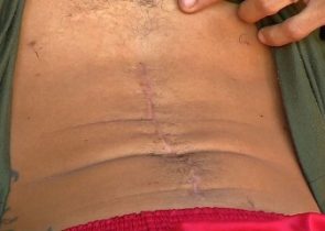 Homem foi internado em MT para retirar bala da coluna e saiu do hospital sem um rim