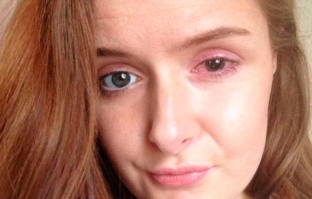 Jovem arranca córnea ao retirar lente de contato após 12 horas de uso