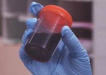 Médicos descobrem origem da doença misteriosa que deixa a urina preta