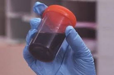 Médicos descobrem origem da doença misteriosa que deixa a urina preta