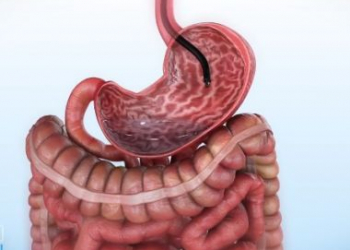 Redução de estômago por endoscopia é testada no Brasil