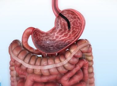 Redução de estômago por endoscopia é testada no Brasil